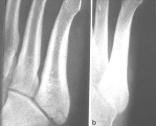 cpt orif 5th metatarsal fracture cpt orif 5th metatarsal fracture