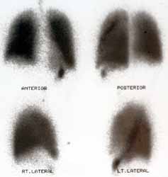 Normal ventilation imagings