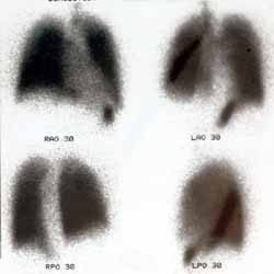 Normal ventilation imagings